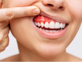 Gum Diseases Treatment